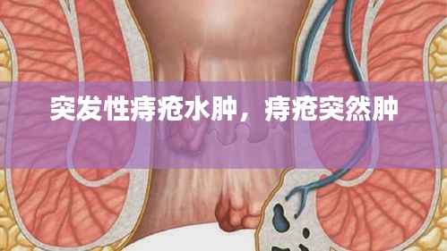 突发性痔疮水肿,痔疮突然肿